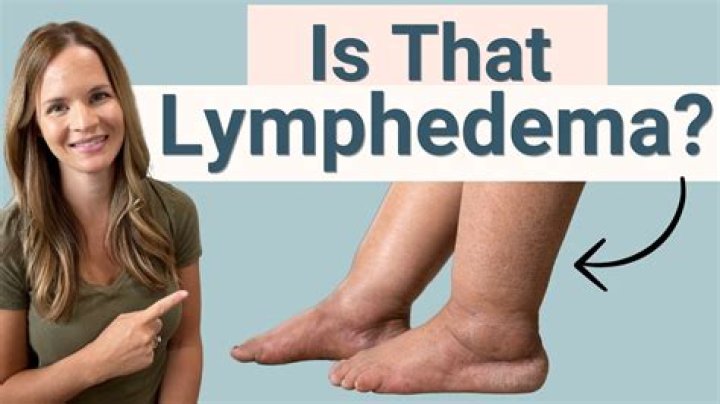 Living With Lymphoedema: A Woman's Journey