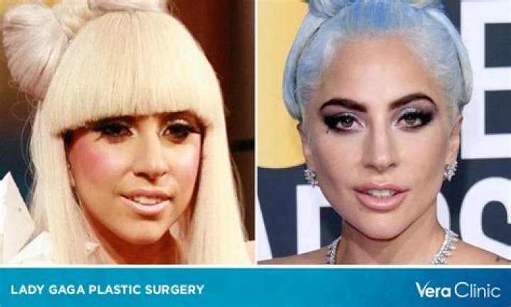 [PICS] Did Lady Gaga Get A Nose Job? Plastic Surgeon Speaks After X Factor Hollywood Life |