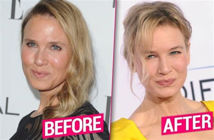 Renee Zellwegers Face She Got Plastic Surgery, Docs Say Hollywood Life |