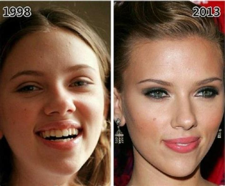 Scarlett Johansson's Plastic Surgery Journey Revealed